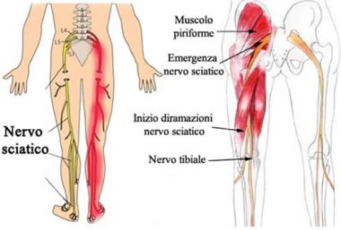 sciatica2