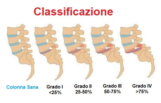 classificazione-spondilolistesi