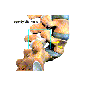 spondilolistesi-istmica
