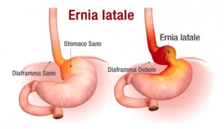 ernia iatale