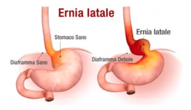 ernia iatale